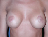 Patient # 11916 After Photo # 2
